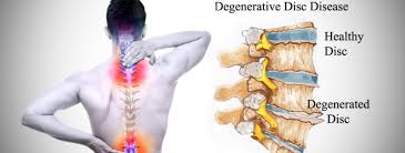 CERVICAL DISC-sharad-hospital-pune