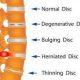 back-pain-disc-herniate-sharad-hospital-pune