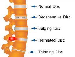 back-pain-disc-herniate-sharad-hospital-pune