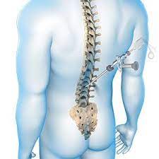 spine-surgery-sharad-orthopedic-hospital-pune-